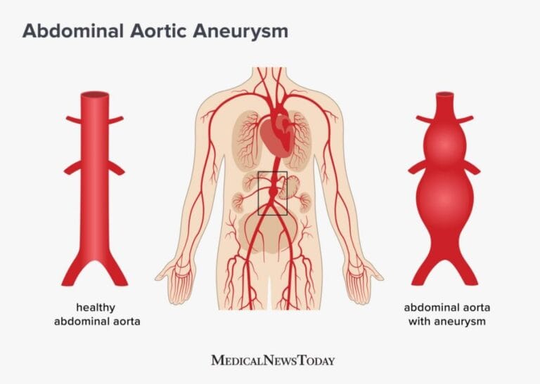 Aortic Aneurysm