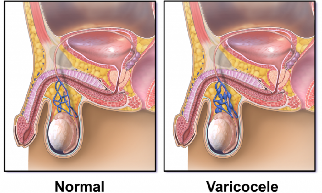 Scrotal Pain (Varicocele)  Vascular & Interventional Centre