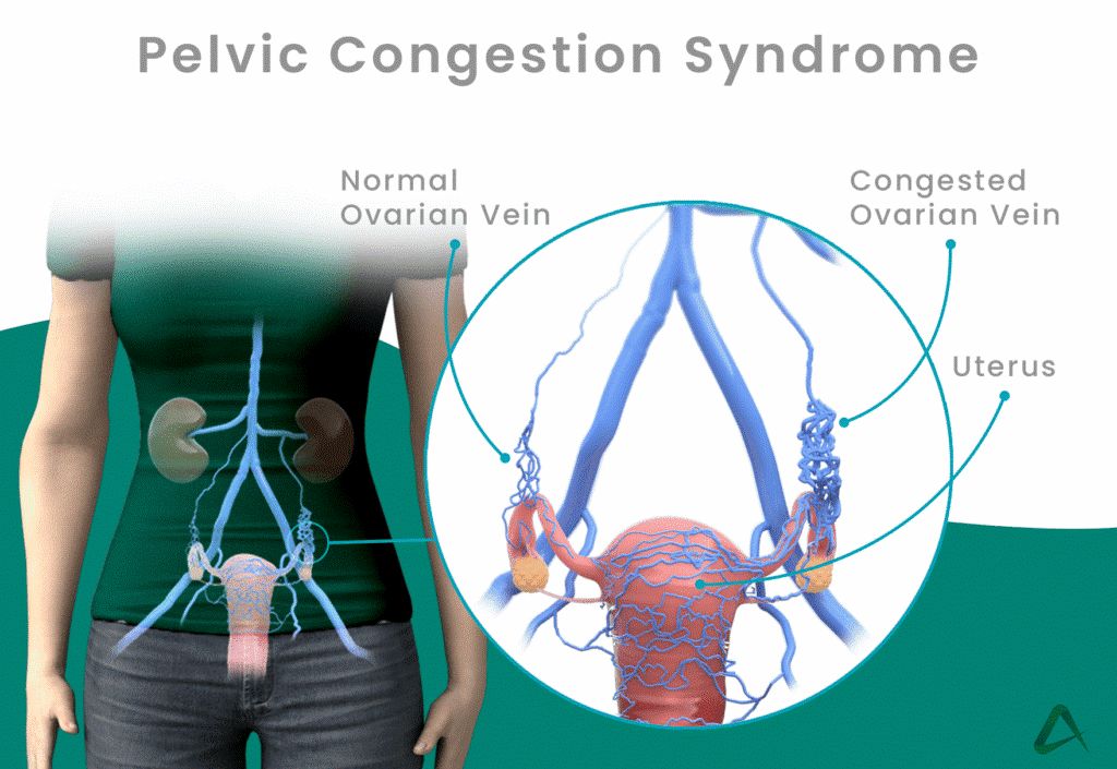 Pelvic Congestion Syndrome and Ovarian Cancer: Are They Connected