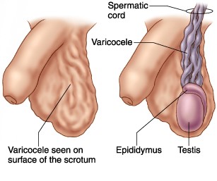 Varicocele Secrets: The Underground Solution for Getting Rid of